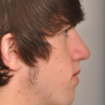 Rhinoplasty Delaware | Premier Cosmetic Surgery DE