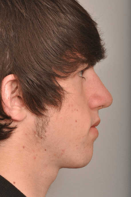 Rhinoplasty Delaware | Premier Cosmetic Surgery DE