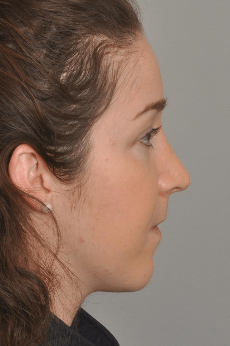 Rhinoplasty Delaware | Premier Cosmetic Surgery DE