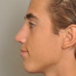 Rhinoplasty Delaware | Premier Cosmetic Surgery DE