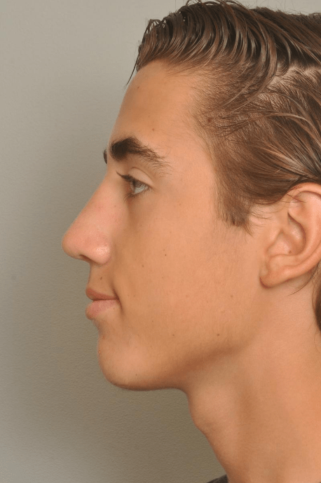 Rhinoplasty Delaware | Premier Cosmetic Surgery DE