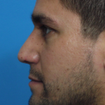 Rhinoplasty Delaware | Premier Cosmetic Surgery DE