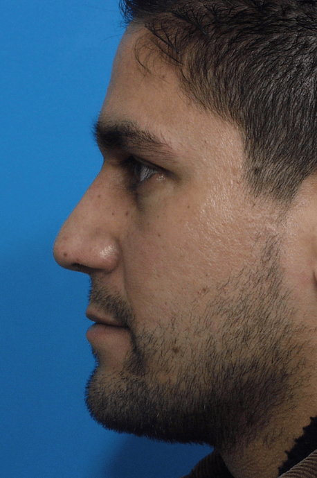 Rhinoplasty Delaware | Premier Cosmetic Surgery DE