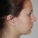 Rhinoplasty Delaware | Premier Cosmetic Surgery DE