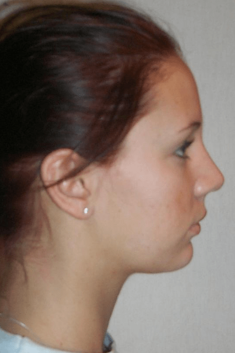 Rhinoplasty Delaware | Premier Cosmetic Surgery DE