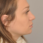 Rhinoplasty Delaware | Premier Cosmetic Surgery DE