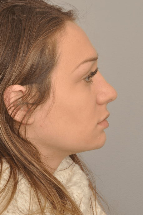 Rhinoplasty Delaware | Premier Cosmetic Surgery DE