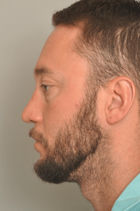 Rhinoplasty Delaware | Premier Cosmetic Surgery DE