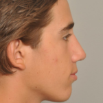 Rhinoplasty Delaware | Premier Cosmetic Surgery DE