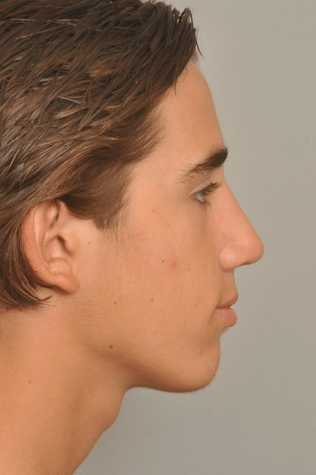 Rhinoplasty Delaware | Premier Cosmetic Surgery DE