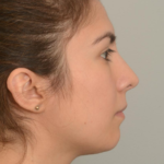 Rhinoplasty Delaware | Premier Cosmetic Surgery DE