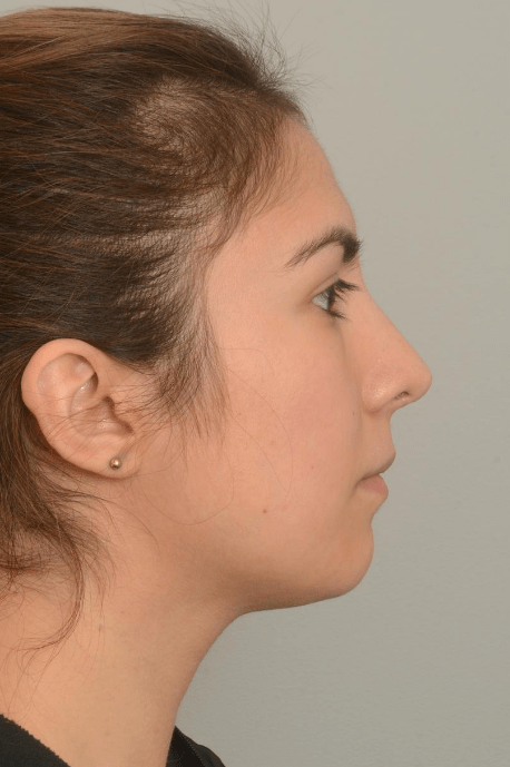 Rhinoplasty Delaware | Premier Cosmetic Surgery DE