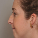 Rhinoplasty Delaware | Premier Cosmetic Surgery DE