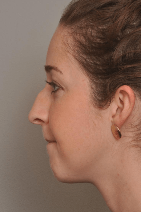 Rhinoplasty Delaware | Premier Cosmetic Surgery DE