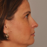 Rhinoplasty Delaware | Premier Cosmetic Surgery DE