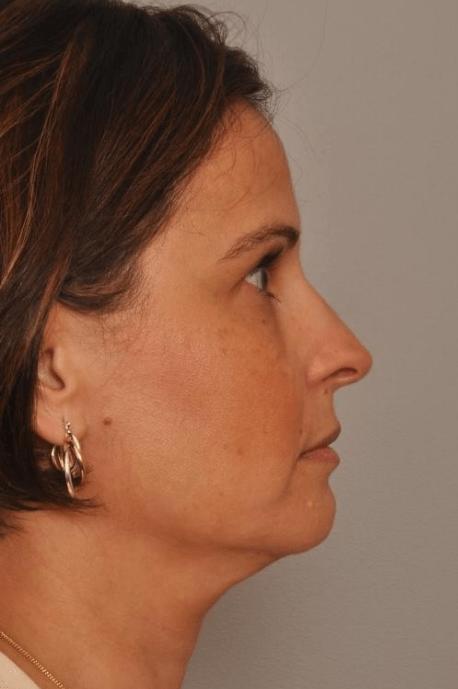 Rhinoplasty Delaware | Premier Cosmetic Surgery DE