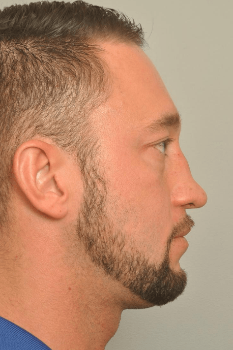 Rhinoplasty Delaware | Premier Cosmetic Surgery DE