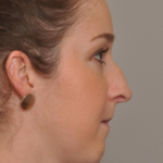 Rhinoplasty Delaware | Premier Cosmetic Surgery DE