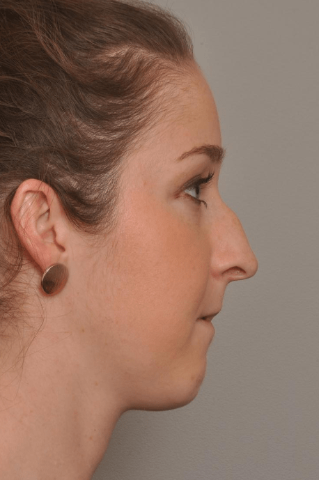 Rhinoplasty Delaware | Premier Cosmetic Surgery DE