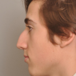 Rhinoplasty Delaware | Premier Cosmetic Surgery DE