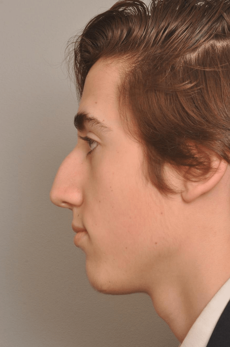 Rhinoplasty Delaware | Premier Cosmetic Surgery DE