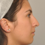 Rhinoplasty Delaware | Premier Cosmetic Surgery DE