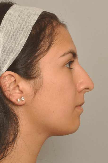 Rhinoplasty Delaware | Premier Cosmetic Surgery DE