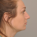 Rhinoplasty Delaware | Premier Cosmetic Surgery DE