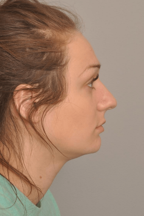 Rhinoplasty Delaware | Premier Cosmetic Surgery DE