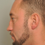 Rhinoplasty Delaware | Premier Cosmetic Surgery DE