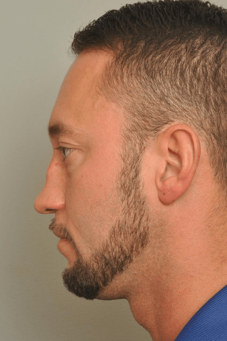 Rhinoplasty Delaware | Premier Cosmetic Surgery DE