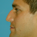 Rhinoplasty Delaware | Premier Cosmetic Surgery DE