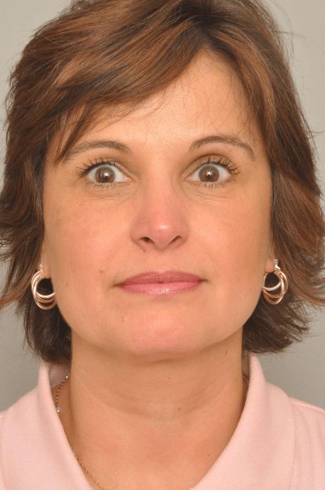 Rhinoplasty Delaware | Premier Cosmetic Surgery DE