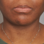 Liposuction Delaware | Premier Cosmetic Surgery DE