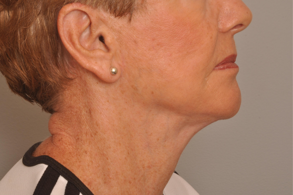 Lower Facelift/Necklift Delaware | Premier Cosmetic Surgery DE