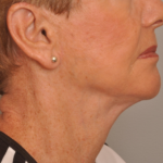 Lower Facelift/Necklift Delaware | Premier Cosmetic Surgery DE