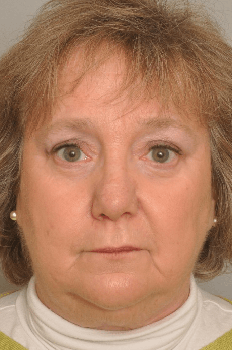 Blepharoplasty Eyelid Surgery | Premier Cosmetic Surgery DE