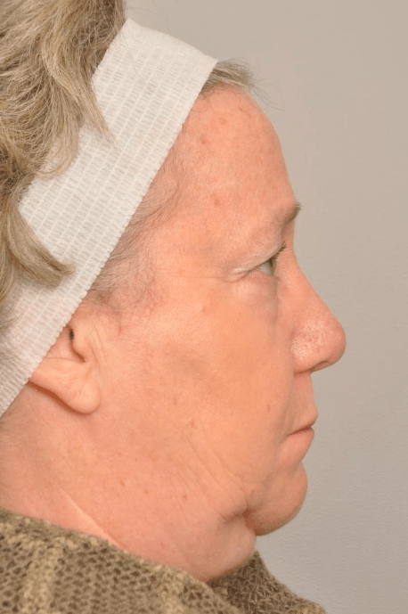 Blepharoplasty Eyelid Surgery | Premier Cosmetic Surgery DE