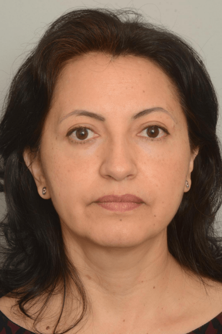 Blepharoplasty Eyelid Surgery Delaware | Premier Cosmetic Surgery DE