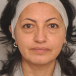 Blepharoplasty Eyelid Surgery Delaware | Premier Cosmetic Surgery DE