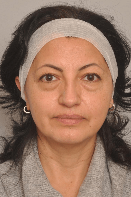 Blepharoplasty Eyelid Surgery Delaware | Premier Cosmetic Surgery DE