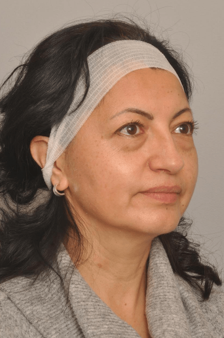 Blepharoplasty Eyelid Surgery Delaware | Premier Cosmetic Surgery DE