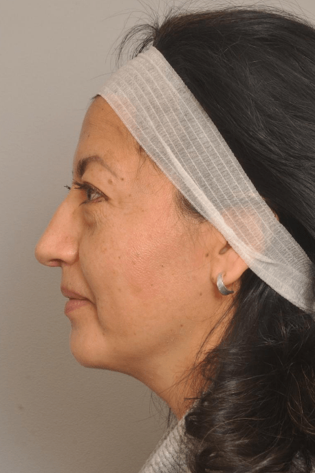 Blepharoplasty Eyelid Surgery | Premier Cosmetic Surgery DE