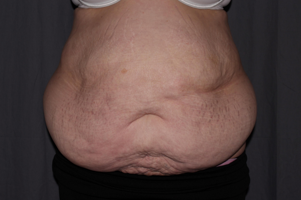 Abdominoplasty Delaware | Premier Cosmetic Surgery DE