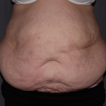 Abdominoplasty Delaware | Premier Cosmetic Surgery DE