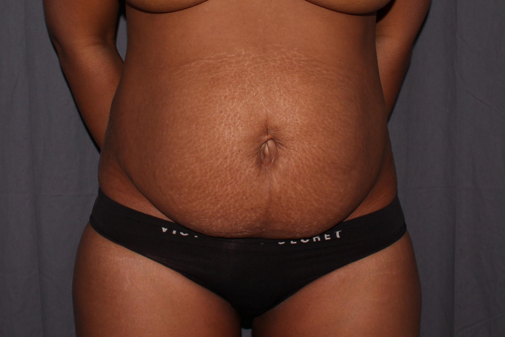 Abdominoplasty Delaware | Premier Cosmetic Surgery DE