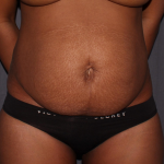 Abdominoplasty Delaware | Premier Cosmetic Surgery DE