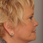 Lower Facelift/Necklift Delaware | Premier Cosmetic Surgery DE