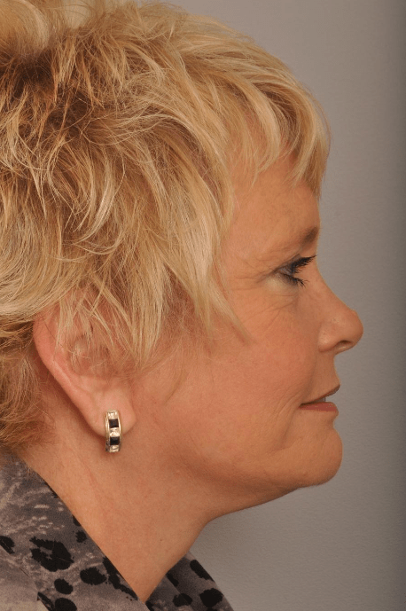 Lower Facelift/Necklift Delaware | Premier Cosmetic Surgery DE