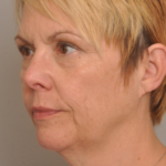 Lower Facelift/Necklift Delaware | Premier Cosmetic Surgery DE